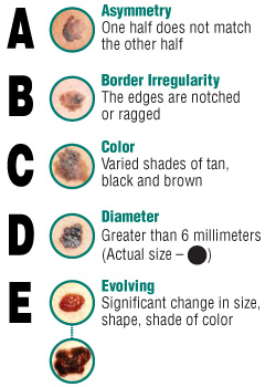 The ABCDE of skin checks for skin cancer